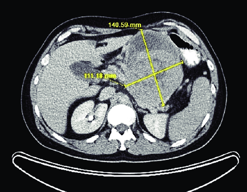 abdominal neoplasm tumors in ct abdomen