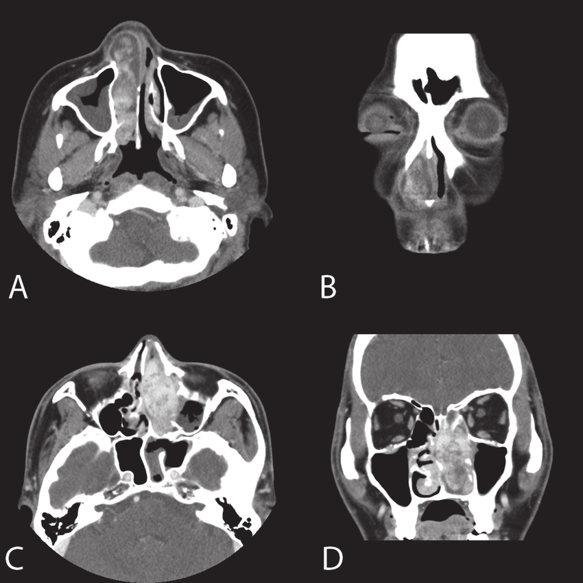 CT Scan PNS Axial + Coronal