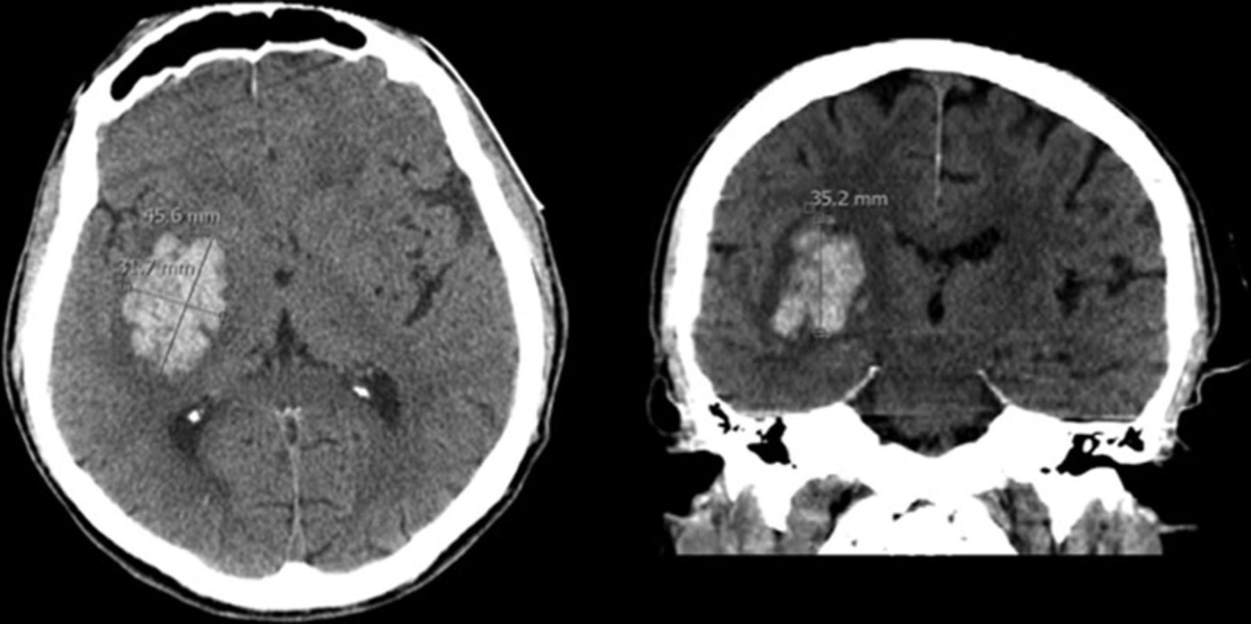 Brain Hemorrhage ,CVA And CT