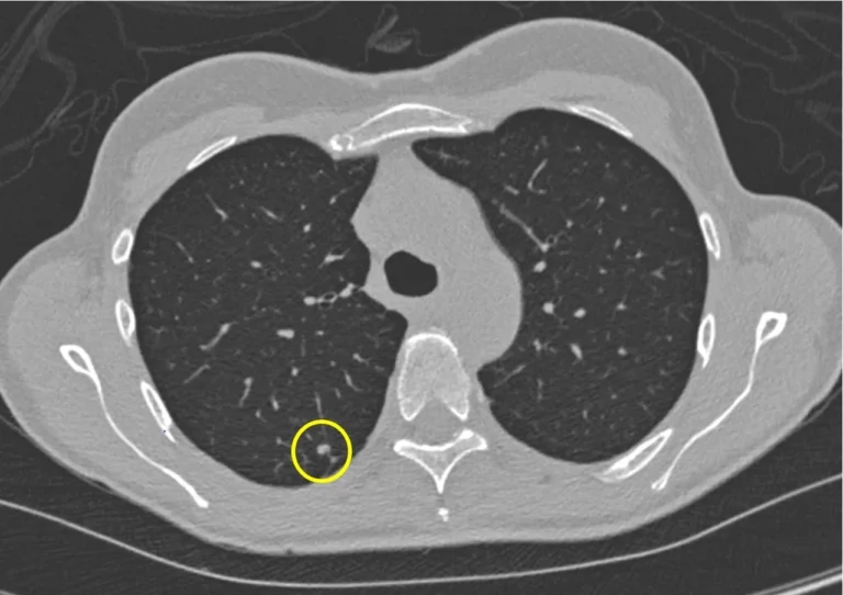 lung cancer in ct scan