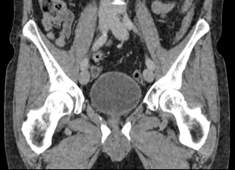 CT Pelvis