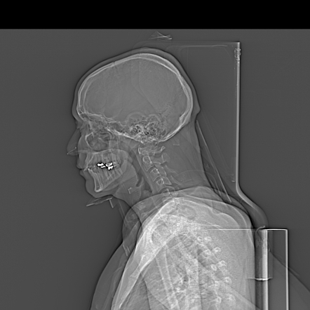 Trauma Protocol ( Head + C Spine )