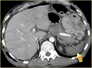 trauma and ct