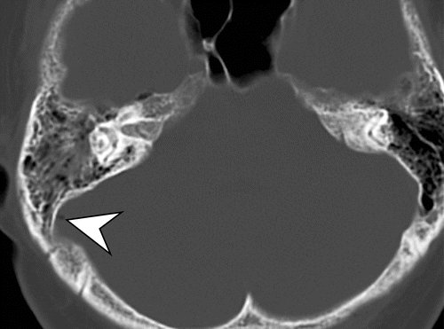 ct for bone trauma